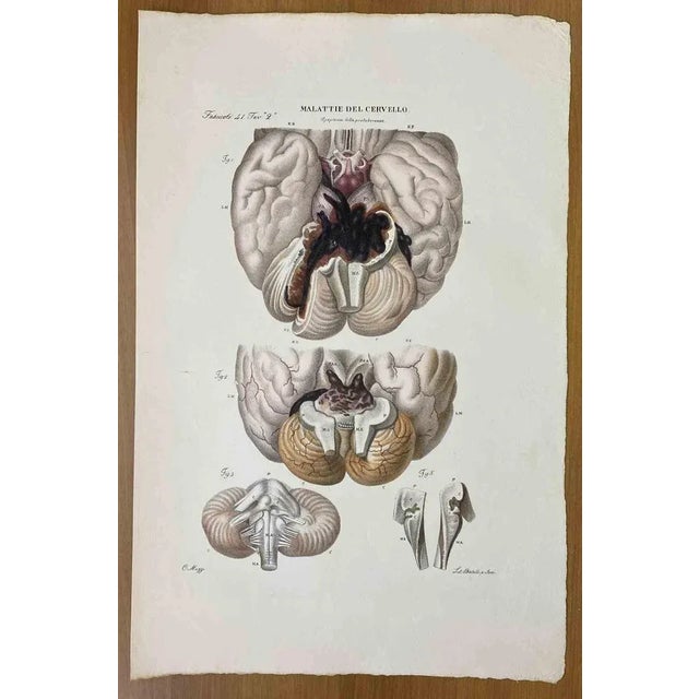 Brain Diseases is a lithograph hand colored by Ottavio Muzzi for the edition of Antoine Chazal, Human Anatomy, Printers...