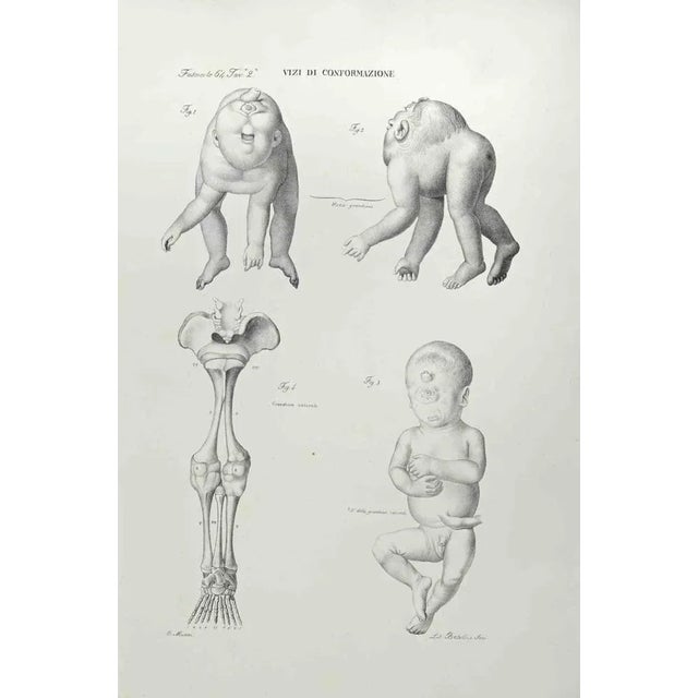 Conformation Defects is a lithograph realized by Ottavio Muzzi for the edition of Antoine Chazal, Human Anatomy, Printers...