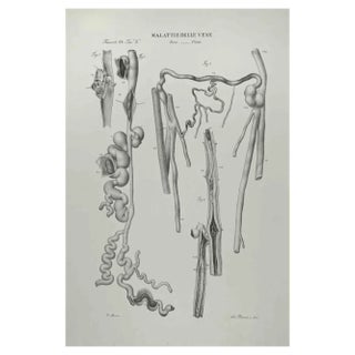 Ottavio Muzzi, Vein Diseases, Lithograph, 1843 For Sale