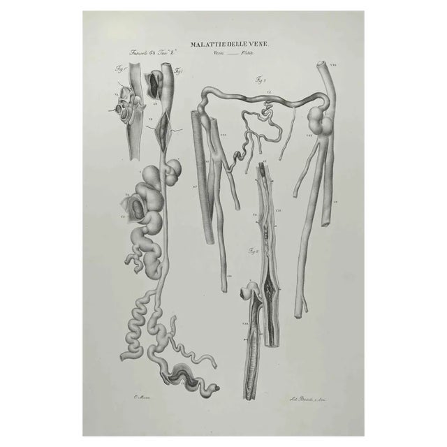 Ottavio Muzzi, Vein Diseases, Lithograph, 1843 For Sale