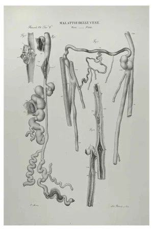 Ottavio Muzzi, Vein Diseases, Lithograph, 1843