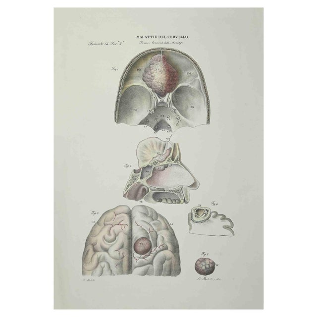 Ottavio Muzzi, Brain Diseases, Lithograph, 1843 For Sale