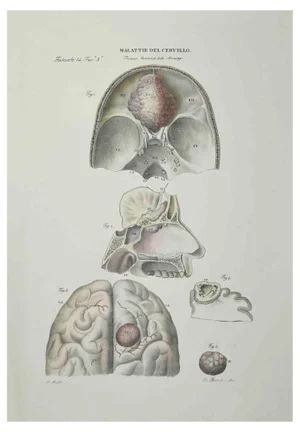 Ottavio Muzzi, Brain Diseases, Lithograph, 1843