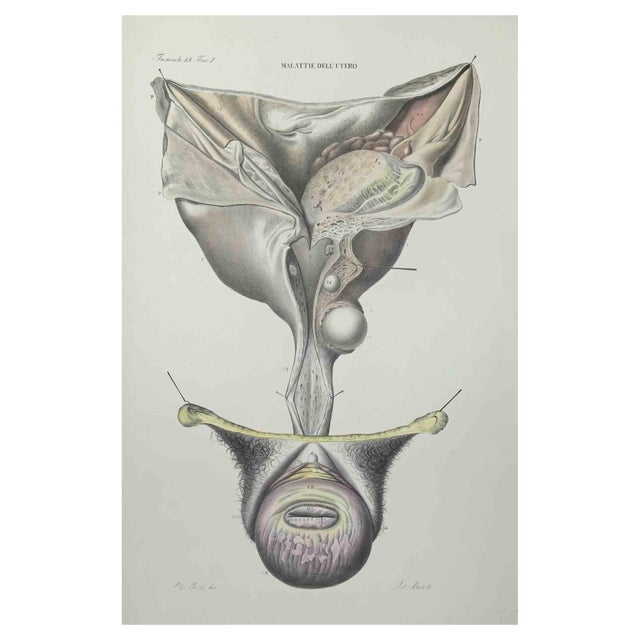 Ottavio Muzzi, Uterus Diseases, Lithograph, 1843 For Sale