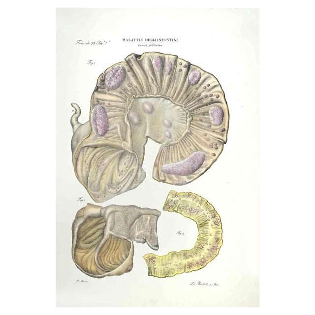 Ottavio Muzzi, Diseases of the Intestines, Lithograph, 1843 For Sale