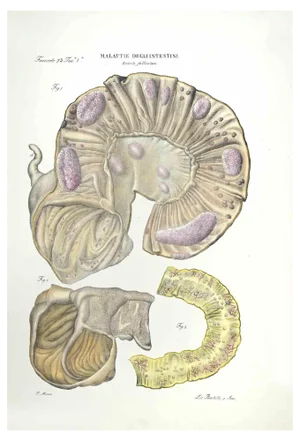 Ottavio Muzzi, Diseases of the Intestines, Lithograph, 1843