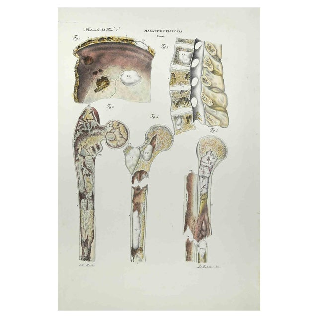 Ottavio Muzzi, Bone Diseases, Lithograph, 1843 For Sale