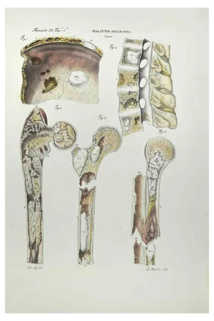 Ottavio Muzzi, Bone Diseases, Lithograph, 1843