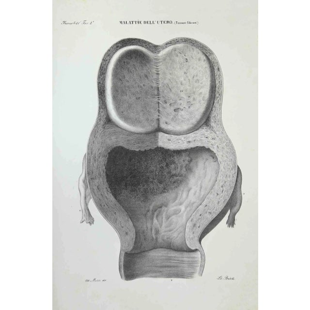 Uterus Diseases is a lithograph hand colored by Ottavio Muzzi for the edition of Antoine Chazal, Human Anatomy, Printers...