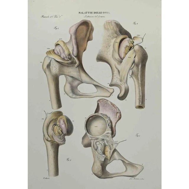 Bone Disease is a lithograph hand colored by Ottavio Muzzi for the edition of Antoine Chazal, Human Anatomy, Printers...