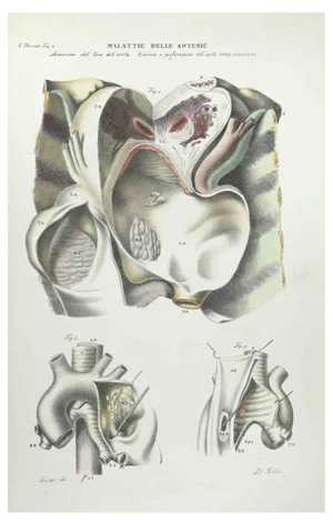 Ottavio Muzzi, Stomach Diseases, Lithograph, 1843