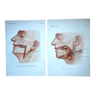 Authentic Antique Anatomical Lithographs-Tongue Surgery-Medical or Macabre?-A Pair For Sale