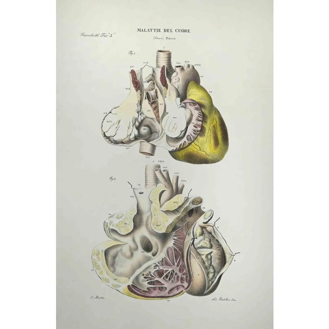 Ottavio Muzzi, Heart Disease, Lithograph, 1843 For Sale