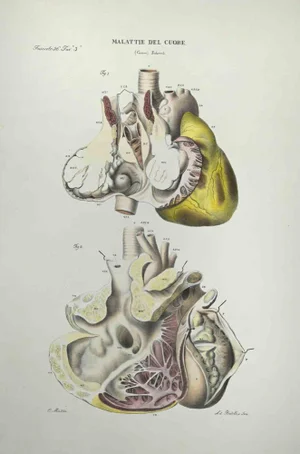 Ottavio Muzzi, Heart Disease, Lithograph, 1843
