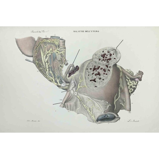 Uterus Diseases is a lithograph hand colored by Ottavio Muzzi for the edition of Antoine Chazal,Human Anatomy, Printers...