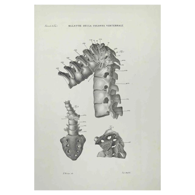 Ottavio Muzzi, Vertebral Column Diseases, Lithograph, 1843 For Sale