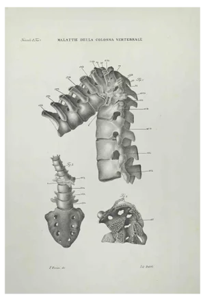 Ottavio Muzzi, Vertebral Column Diseases, Lithograph, 1843
