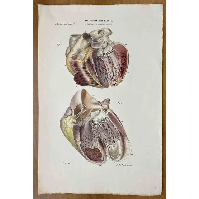 Heart Diseases is a lithograph hand colored by Ottavio Muzzi for the edition of Antoine Chazal, Human Anatomy, Printers...