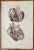 Heart Diseases is a lithograph hand colored by Ottavio Muzzi for the edition of Antoine Chazal, Human Anatomy, Printers...