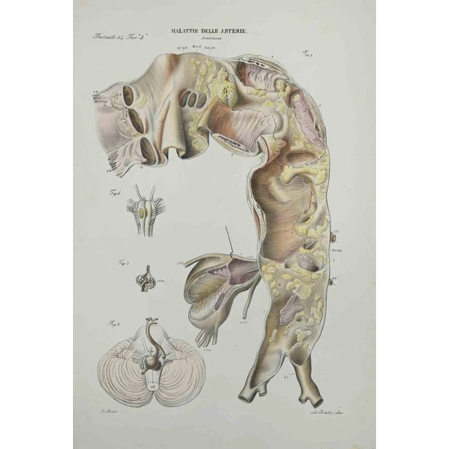 Ottavio Muzzi, Artery Disease, Lithograph, 1843 For Sale