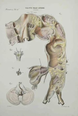 Ottavio Muzzi, Artery Disease, Lithograph, 1843