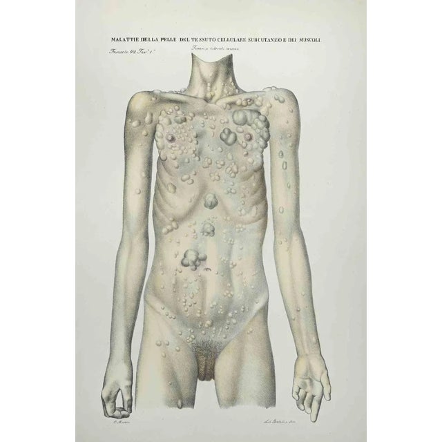 Ottavio Muzzi, Skin Diseases of Subcutaneous Cell Tissue and Muscles, Lithograph, 1843 For Sale