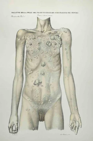 Ottavio Muzzi, Skin Diseases of Subcutaneous Cell Tissue and Muscles, Lithograph, 1843