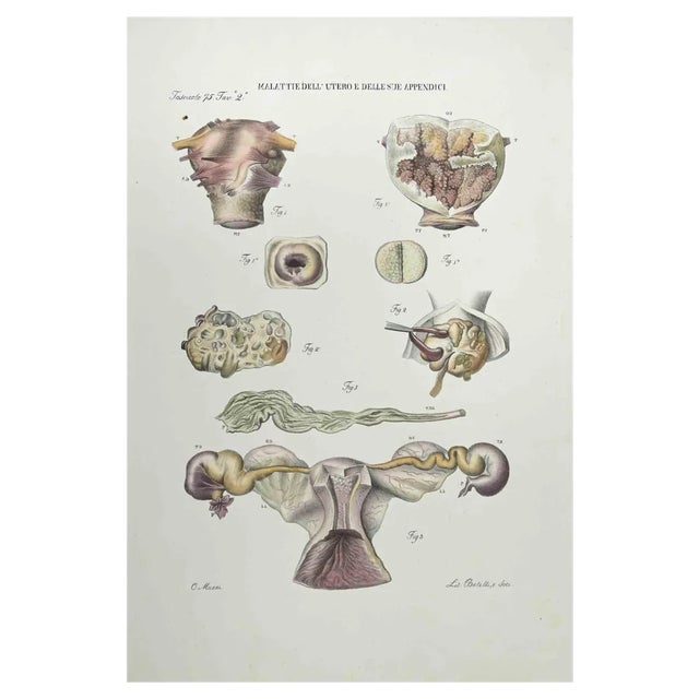 Ottavio Muzzi, Diseases of the Uterus and its Appendages, Lithograph, 1843 For Sale