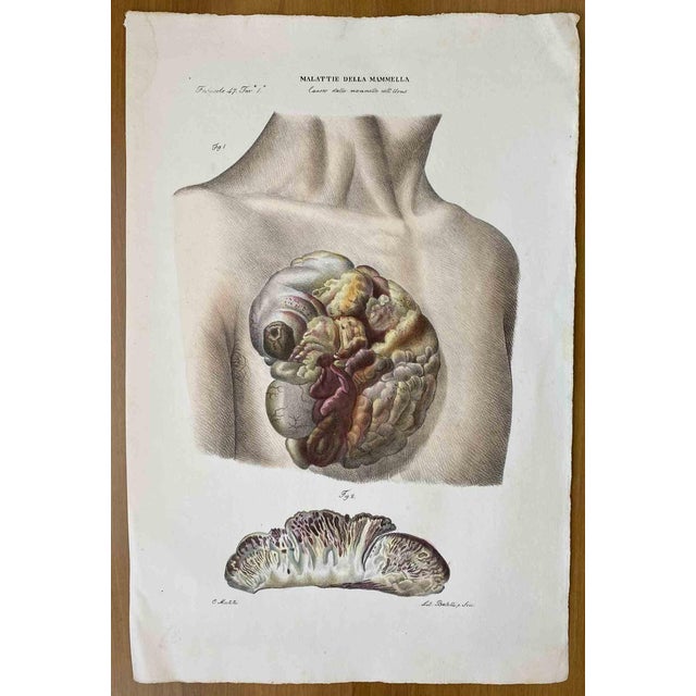 Ottavio Muzzi, Breast Diseases, Lithograph, 1843 For Sale