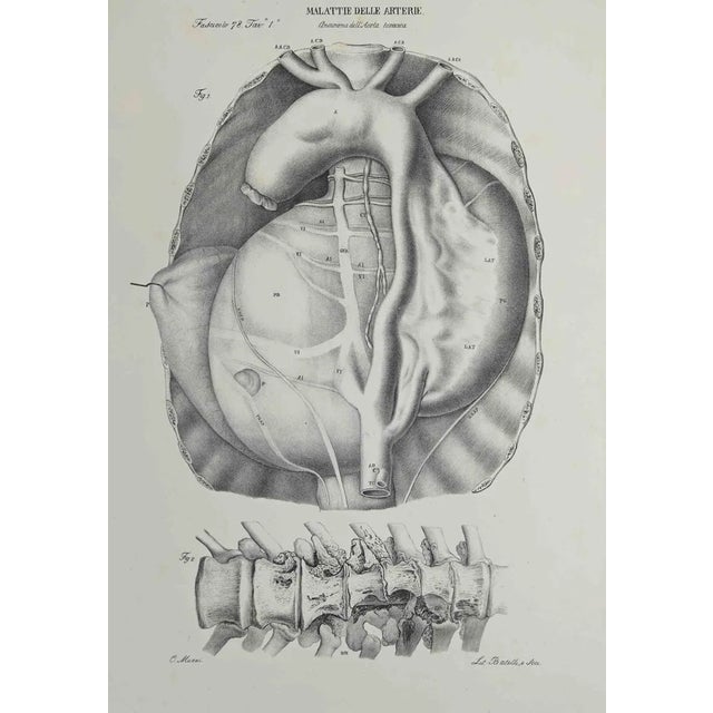 Ottavio Muzzi, Artery Disease, Lithograph, 1843 For Sale