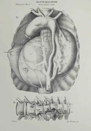 Ottavio Muzzi, Artery Disease, Lithograph, 1843
