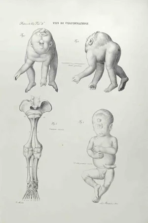 Ottavio Muzzi, Conformation Defects, Lithograph, 1843