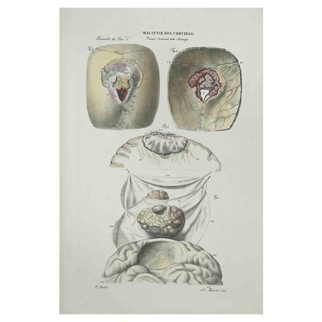 Ottavio Muzzi, Brain Diseases, Lithograph, 1843 For Sale