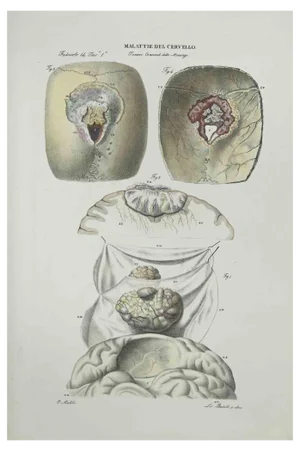 Ottavio Muzzi, Brain Diseases, Lithograph, 1843