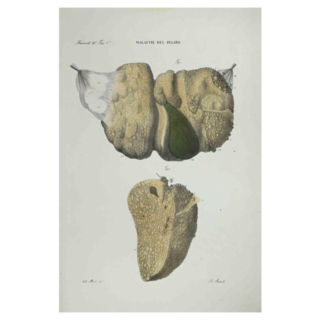 Ottavio Muzzi, Liver Diseases, Lithograph, 1843 For Sale