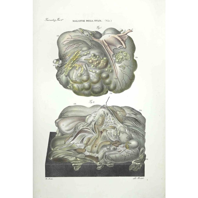 Brain Diseases is a lithograph hand colored by Ottavio Muzzi for the edition of Antoine Chazal, Human Anatomy, Printers...