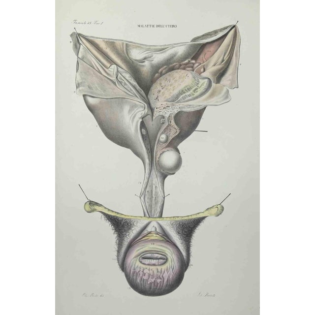 Uterus Diseases is a lithograph hand colored by Ottavio Muzzi for the edition of Antoine Chazal,Human Anatomy, Printers...