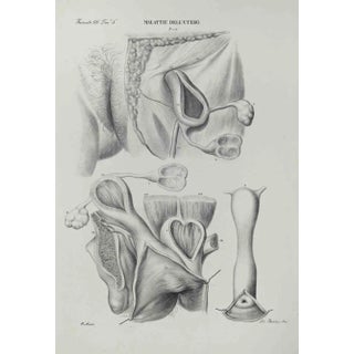 Ottavio Muzzi, Diseases of the Uterus, Lithograph, 1843 For Sale