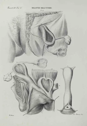 Ottavio Muzzi, Diseases of the Uterus, Lithograph, 1843