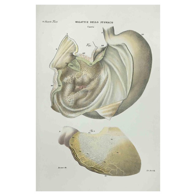 Ottavio Muzzi, Stomach Diseases, Lithograph, 1843 For Sale