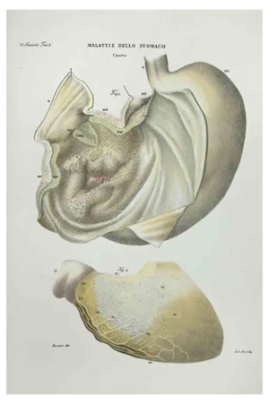 Ottavio Muzzi, Stomach Diseases, Lithograph, 1843