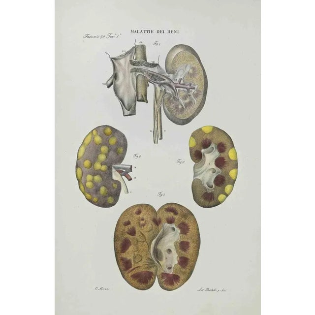 Kidney Disease is a lithograph hand colored by Ottavio Muzzi for the edition of Antoine Chazal, Human Anatomy, Printers...