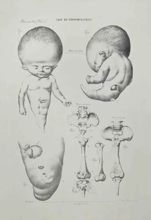 Ottavio Muzzi, Conformation Defects, Lithograph, 1843