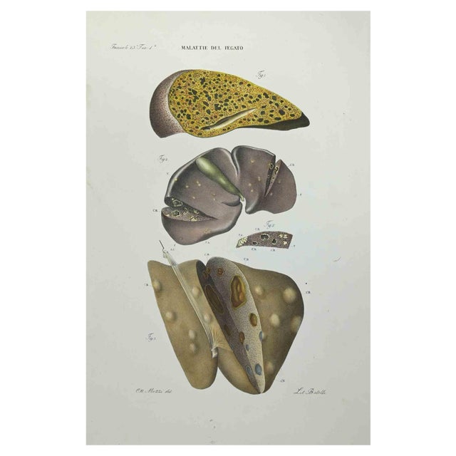 Ottavio Muzzi, Liver Disease, Lithograph, 1843 For Sale