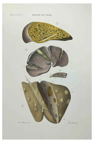 Ottavio Muzzi, Liver Disease, Lithograph, 1843