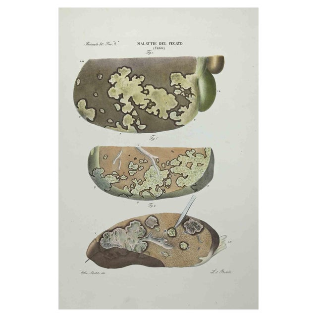 Ottavio Muzzi, Liver Diseases, Lithograph, 1843 For Sale