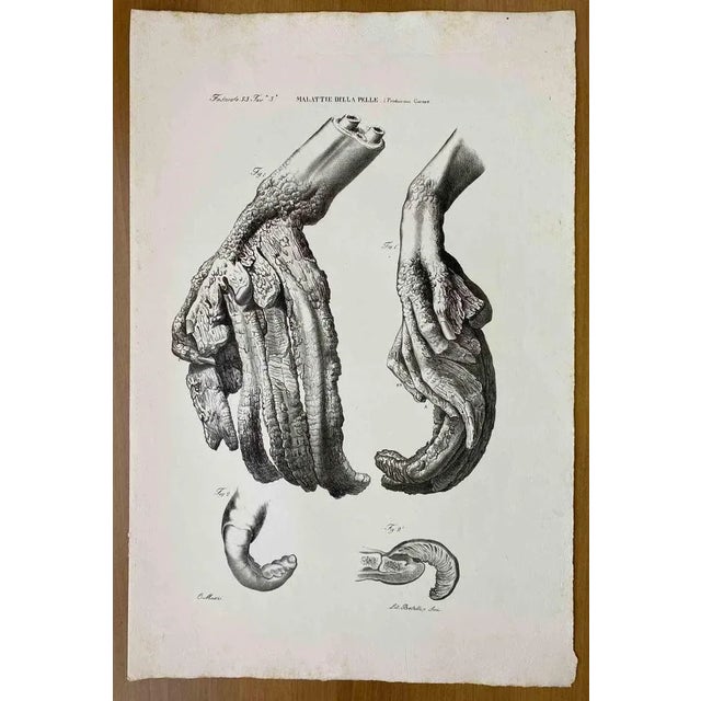 Skin Diseases is a lithograph hand colored by Ottavio Muzzi for the edition of Antoine Chazal, Human Anatomy, Printers...