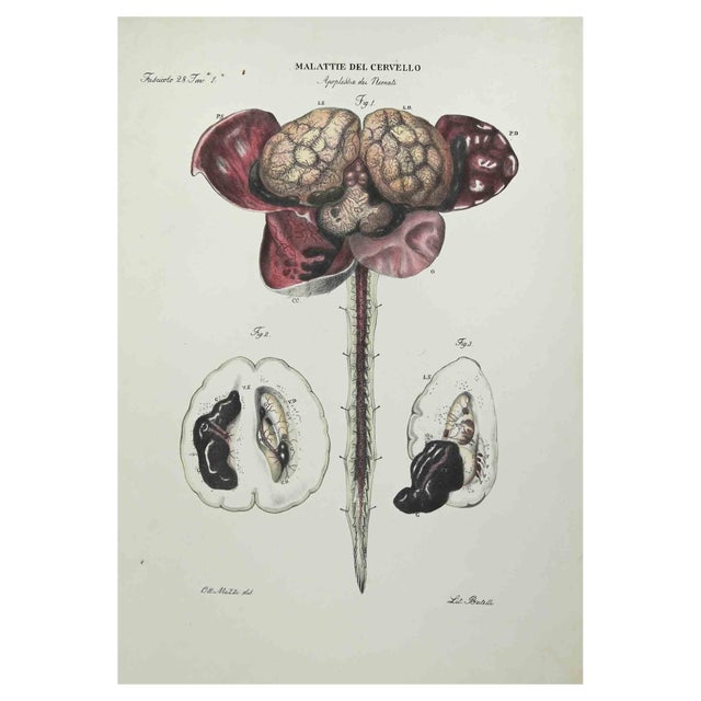 Ottavio Muzzi, Brain Diseases, Lithograph, 1843 For Sale