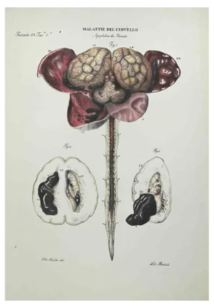 Ottavio Muzzi, Brain Diseases, Lithograph, 1843