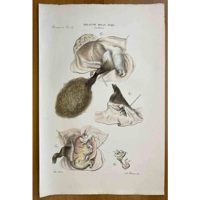 Diseases of the Ovary is a lithograph hand colored by Ottavio Muzzi for the edition of Antoine Chazal, Human Anatomy,...